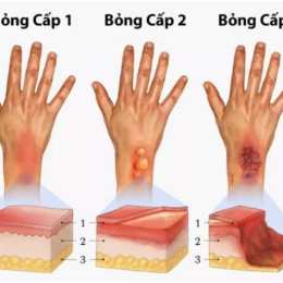 bị bỏng dạ