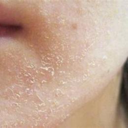 da bị khô bong tróc