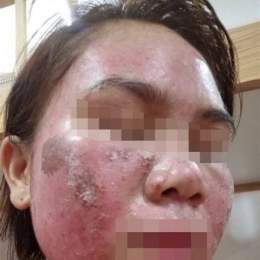 da mặt bị bong tróc đỏ rát