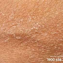 da mặt bị bong tróc vảy trắng