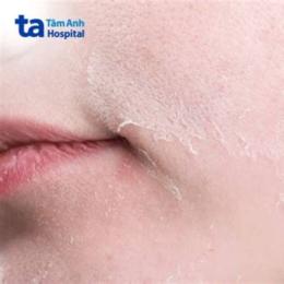da mặt bị bong tróc
