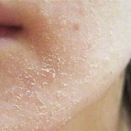 da mặt khô bong tróc nên dùng gì