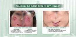 giao diện app dấu hiệu peel da bị bỏng