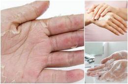 hướng dẫn sử dụng bị bong da tay là thiếu chất gì