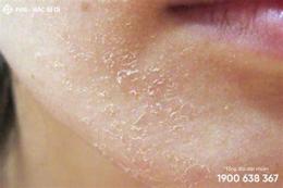 hướng dẫn sử dụng da mặt bị bong tróc vảy trắng