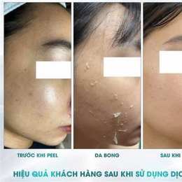 peel da không bong tróc