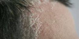 tính năng nổi bật cách trị da đầu khô bong tróc tại nhà