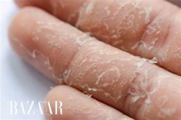 tính năng nổi bật da tay bị bong tróc khô