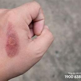 vết bỏng bị tróc da nên bôi gì